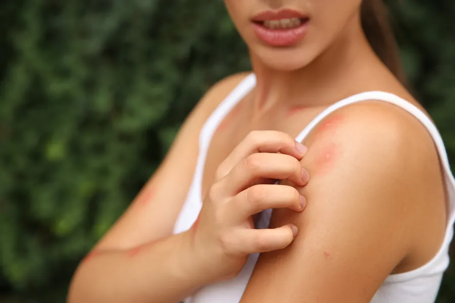 Person scratching itchy red insect bites on shoulder — flea, tick, and mosquito treatment